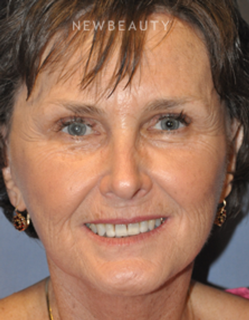 Dr. Bryan W. Gawley - Facelift - After