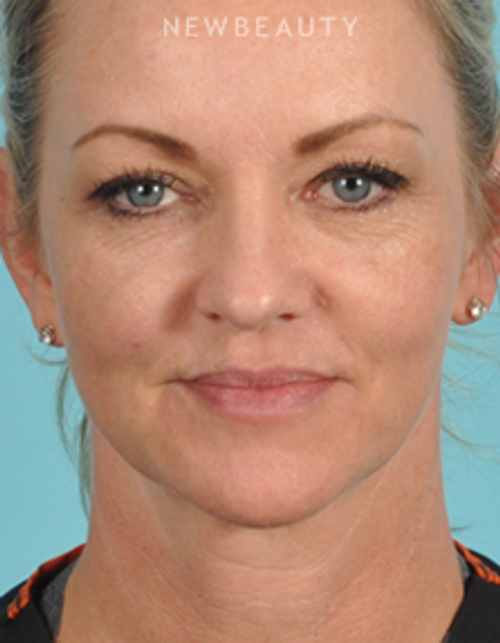 Dr. Bradley Bengtson - Injectables & Fillers - After