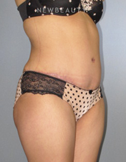 Dr. German Newall - Slimmer Profile - After