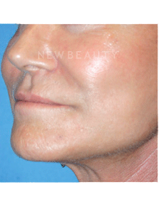 Dr. Kelly Bomer Liquid Facelift - Before