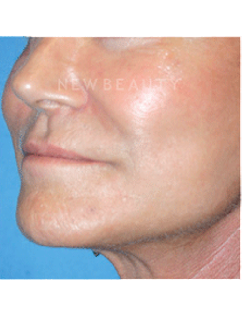 Dr. Kelly Bomer Liquid Facelift - Before
