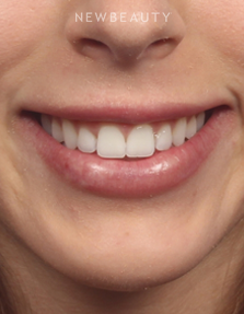 Dr. Kelly Bomer - Botox - After