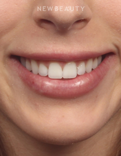Dr. Kelly Bomer - Botox - After