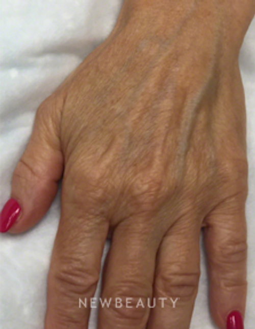 Dr. Kally Papantoniou - Radiesse - Before