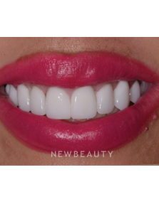 Dr. Guy Lewis - Gum Lift - After