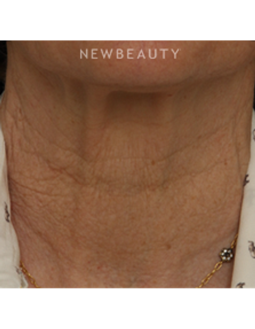Drs. Jennifer Segal & Scott Smith - Microneedling - Before