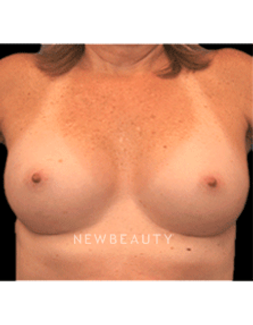 Dr. Christine Hamori Breast Enhancement - After