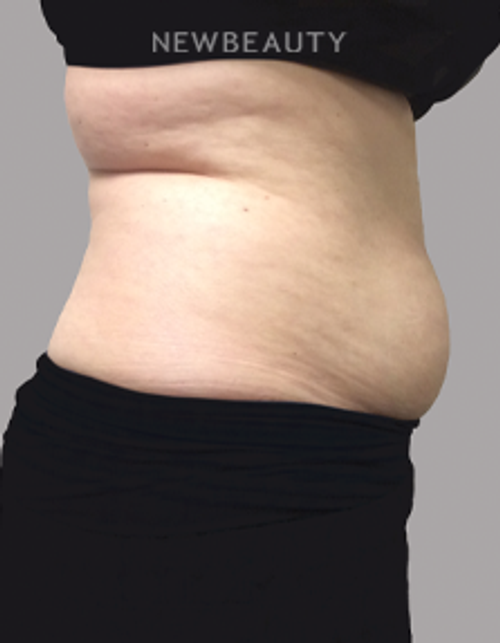 Dr. Linda Honet - Coolsculpting - 15045111 - Before