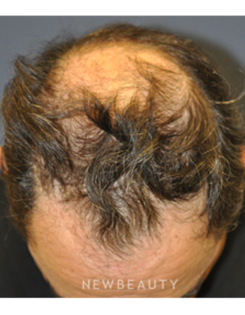 Drs. Lieberman & Parikh - Hair Restoration - Before
