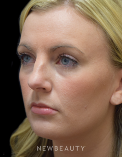 Dr. Jeffrey B. Wise - Natural-Looking Enhancement - Before