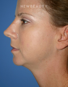 Dr. Kelly Bomer - Liquid Facelift - Before