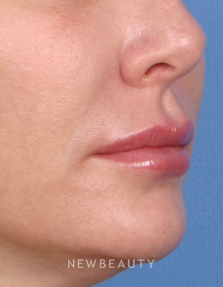 Dr Kelly Bomer Injectable Fillers - Before