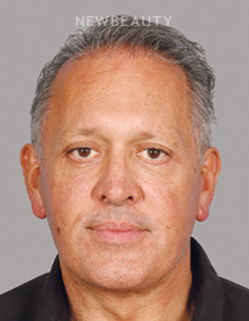 Dr. Mahabir - Traditional Facelift - 20637920 - After