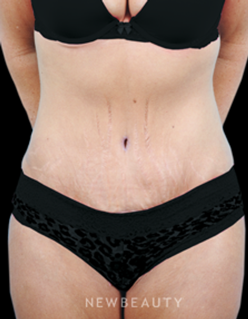 Dr. Bradley Bengtson - Tummy Tuck - After