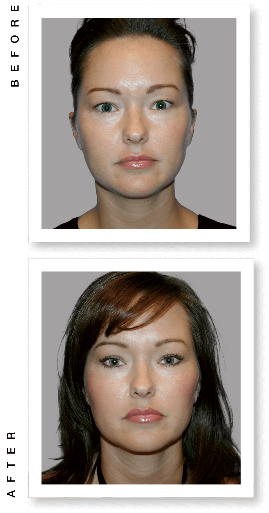 Before and after images of upper bleph