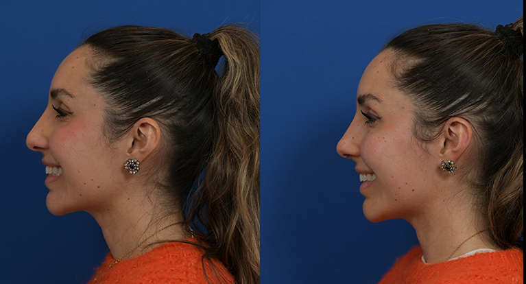 before and after nonsurgical rhinoplasty