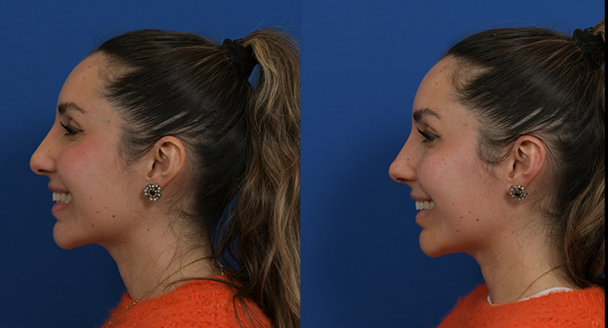 before and after nonsurgical rhinoplasty