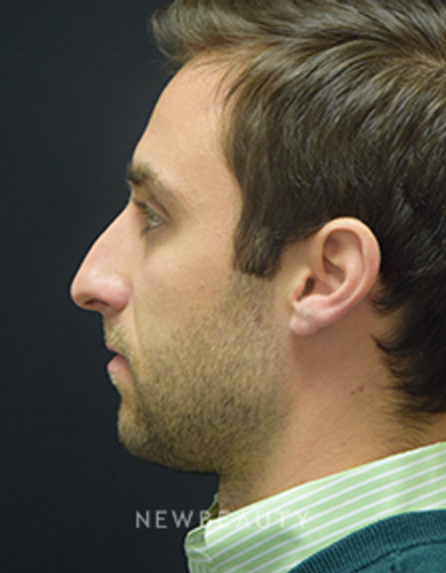 Dr. Jeffrey B. Wise - Rhinoplasty - Before