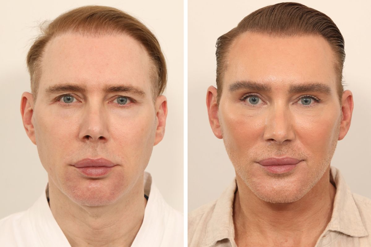 Kristofer Buckle facelift before and after
