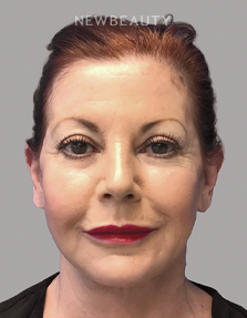 Dr. Paul Afrooz - Full-Face Rejuvenation - After