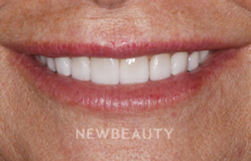 Dr. Sara Cummins - Smile Makeover - 14738055 - After