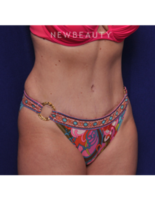 Dr. Alan Durkin - Tummy Tuck - After
