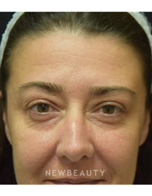 Dr. Jeffrey B. Wise - Eyelift - Before