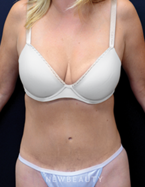 Dr. Mokhtar Asaadi Tummy Tuck, Vaser Lipo - After