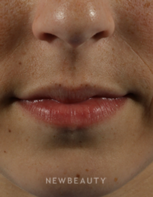 Dr. Marina Peredo - Restylane - After