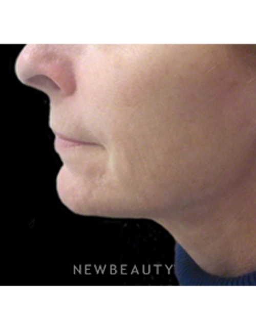 Dr. Kally Papantoniou - Nonsurgical Skin Tightening - After