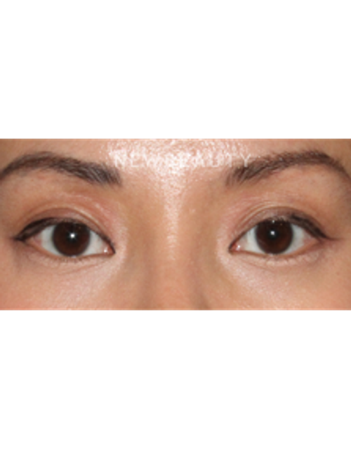Dr. Lily Lee - Asian Eyelid Revision Surgery - Before