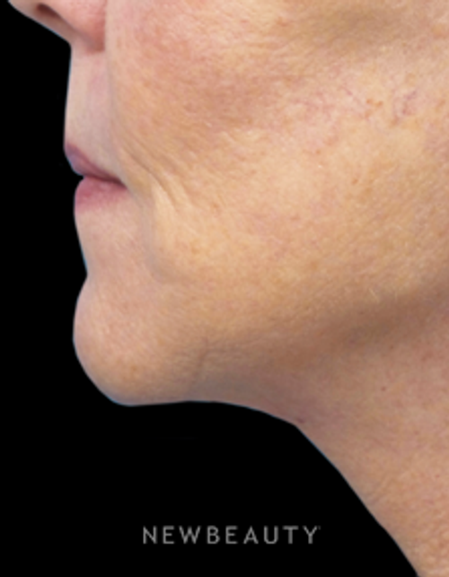 Dr. Christine Hamori - A Subtle, Natural-Looking Lift - After