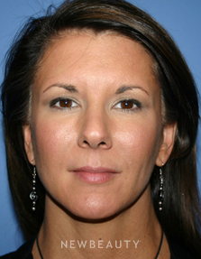 Dr. Kelly Bomer Liquid Facelift - After