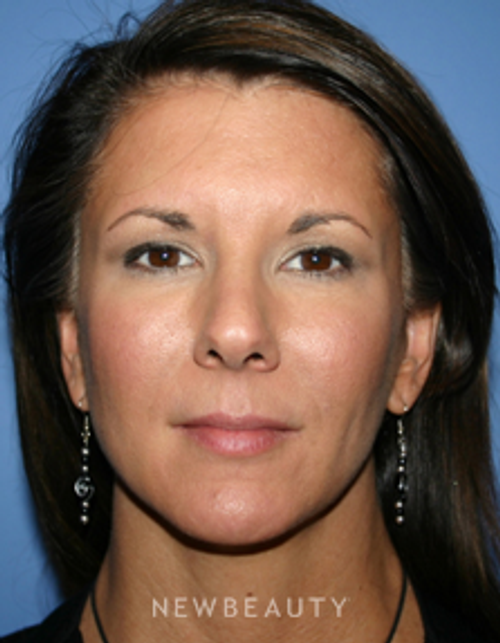 Dr. Kelly Bomer Liquid Facelift - After