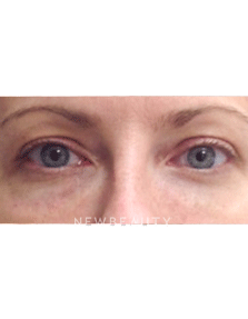 Dr. Julie Russak Injectables & Fillers - After
