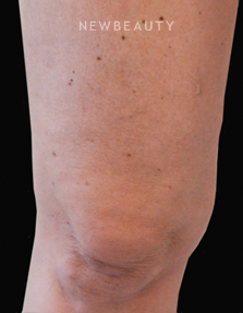 Dr. Julie Russak - Skin Tightners - After