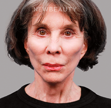 Dr. Michael Zwicklbauer - Youthful Restoration - 44689427 - After