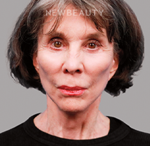 Dr. Michael Zwicklbauer - Youthful Restoration - 44689427 - After