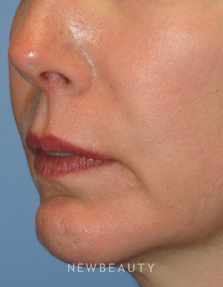 Dr. Kelly Bomer, Facelift, Chin Augmentation - Before