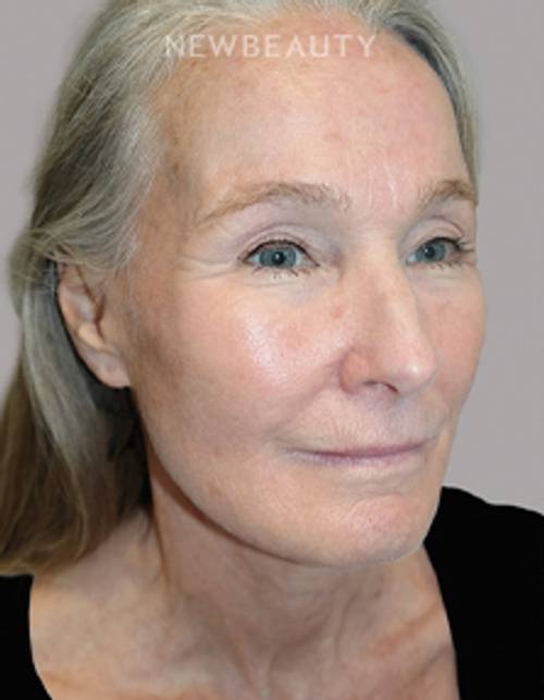 Dr. Sanjay Grover - Facelift - 49726589 - After