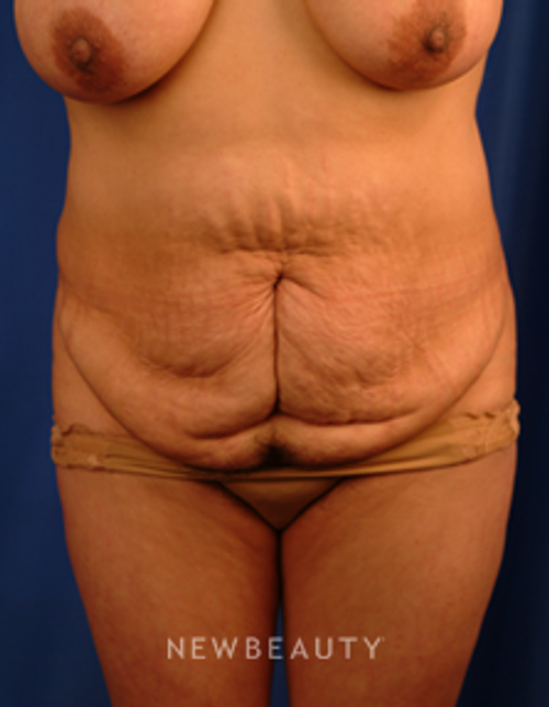 Dr. Peter Geldner Abdominoplasty with Vaser Liposuction - Before