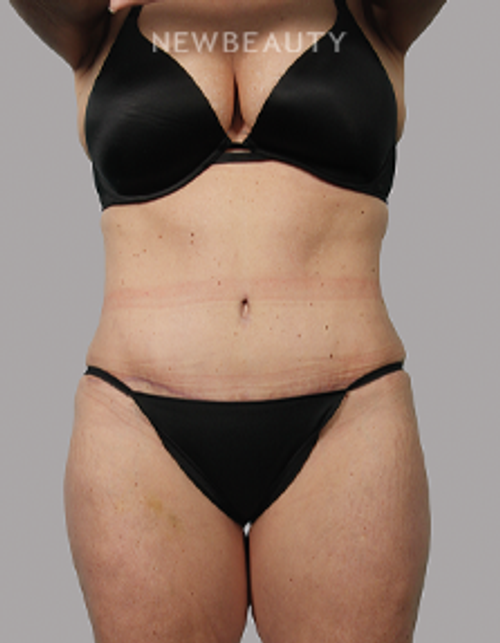 Dr. Michael McNeel - Tightening Transformation - 44726082 - After