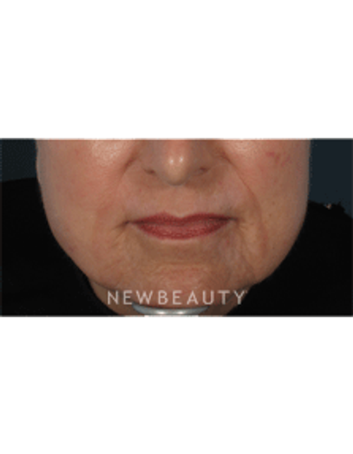 Dr. Gilly Munavalli Lasers - After