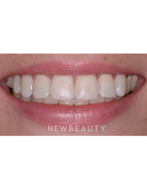 Dr. Irene Grafman - Cosmetic Bonding - After