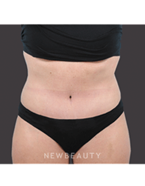 Dr. Bradley Bengtson Liposuction, Tummy Tuck - After