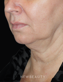 Dr. Min Ahn - Facelift, Necklift, Laser Treatment - Before