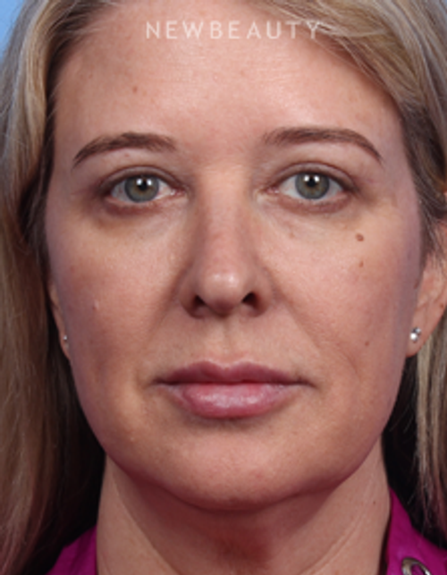 Dr. Kelly Bomer - Upper Blepharoplasty & Liquid Facelift - After