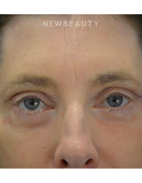 Dr. B. Aviva Preminger - Eyelift - After