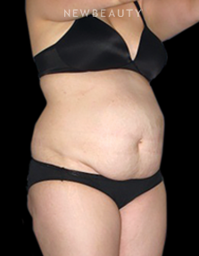 Dr. Henry Mentz - Tummy Tuck - Before