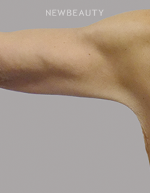 Dr. Jeffrey R. Antimarino - Arm Lift - 25108480 - After